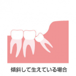 親知らず