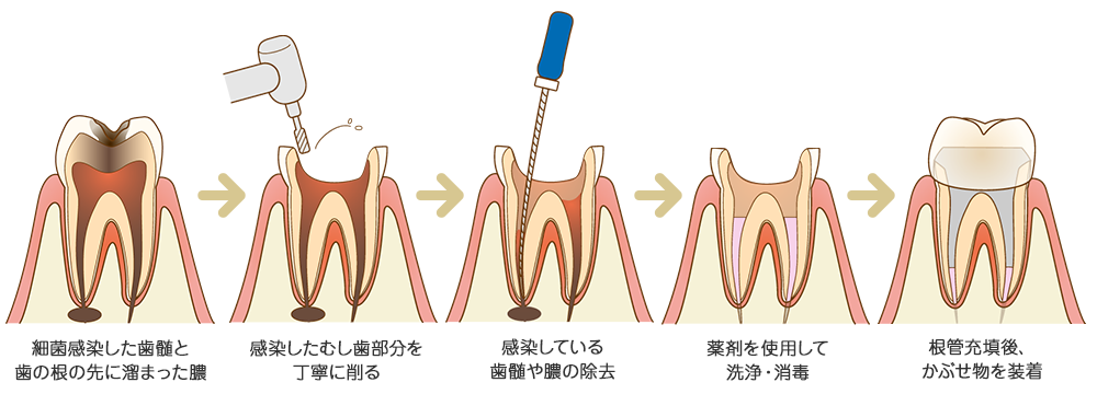 根管治療の流れ